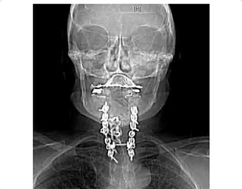 Pre Operative Ct Image Of The Patients Neck Illustrating The Previous