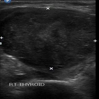 A USG Right Thyroid Heterogeneously Hypo Echoic Nodule With