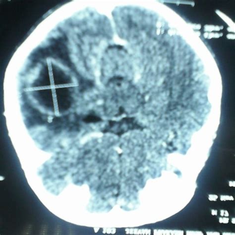 Ct Scan Showing Hypodense Lesion With Peripheral Rim Enhancement In The