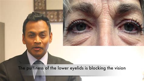 If you're getting eyelid surgery for a medical reason (for instance, because your eyelids are drooping so much that it affects your vision), and if a vision test confirms that, your insurance company may cover it. When does Insurance cover Cosmetic Eyelid Surgery or Blepharoplasty? - YouTube