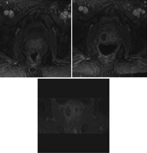 Photodynamic Therapy For Early Prostate Cancer Radiology Key