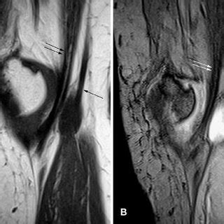 PDF Pes Anserine Bursitis Incidence In Symptomatic Knees And Clinical Presentation