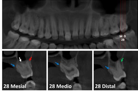 Tercer Molar Superior Con Cuatro Raíces Dento Metric Radiología