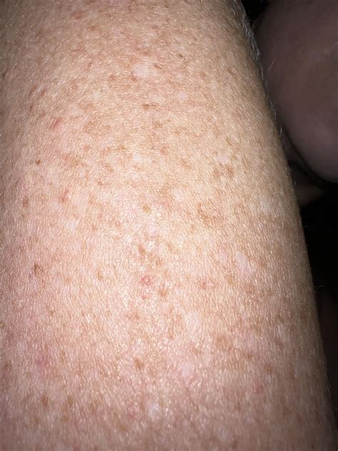 Allergic Reaction Acne Rdermatologyquestions