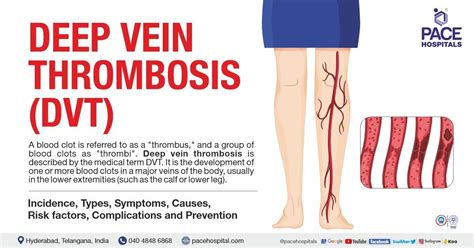 Deep Vein Thrombosis Dvt Symptoms Causes And Complications