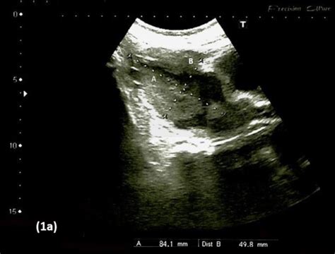 A Pelvic Ultrasound Showed An Enlarged Uterus Measuring 91cmx47cm