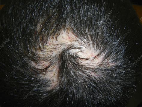 Alopecia Areata In Lupus Erythematosus Stock Image C0549608