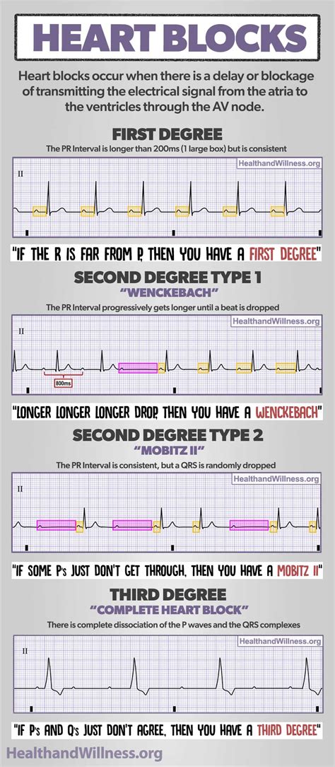 Heart Block Ekg Cheat Sheet The Best Porn Website