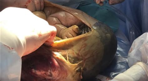 Sometimes we can tell because the baby's liver is enlarged. Extremely rare case of successful birth of full-term baby ...