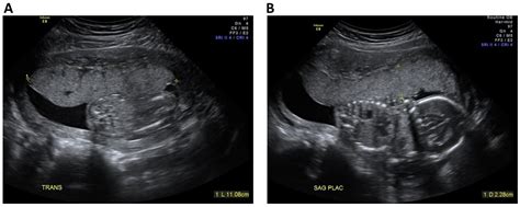 Jcm Free Full Text Contribution Of Second Trimester Sonographic Placental Morphology To