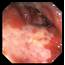 Inflamed Colon Photograph By David M Martin Md