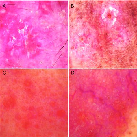 Typical Scales And Follicular Findings Of Rosacea In Dermoscopy A