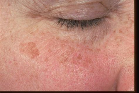 Laser Treat Liver Spots Solar Lentigo — Phillips Aesthetic Dermatology