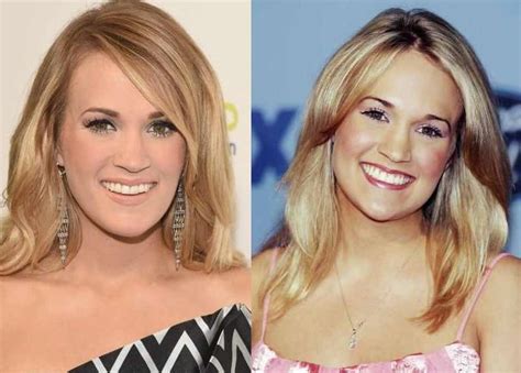 Carrie Underwood Before And After Plastic Surgery Celebrity Plastic