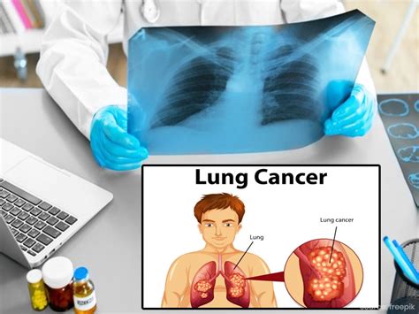 Diagnosing Lung Cancer At An Early Stage Can Save Lives Know About 4