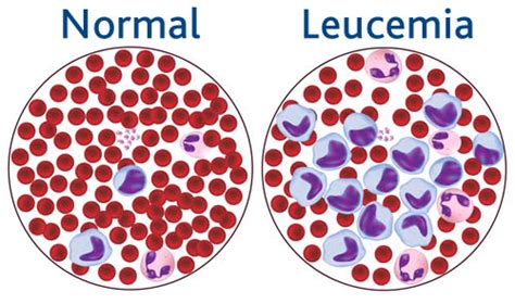10,230 likes · 355 talking about this · 288 were here. Leucemia