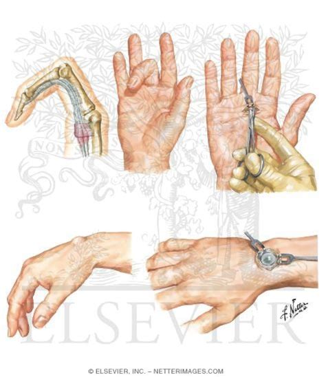 Stenosing Tenosynovitis Of Flexor Tendons Of Fingers
