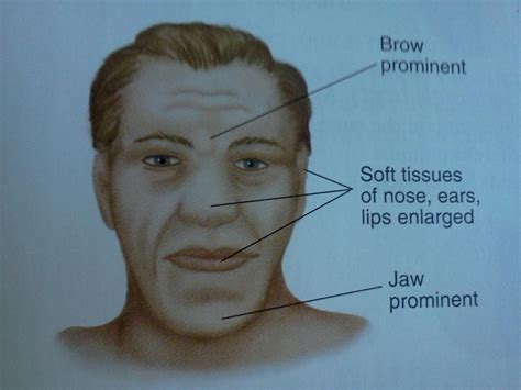 Acromegaly Inappropriate Growth Hormone Secretion Syndrome Acromegaly