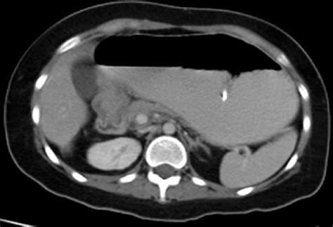 Ct Scan Of The Abdomen With Oral Contrast Demonstrating