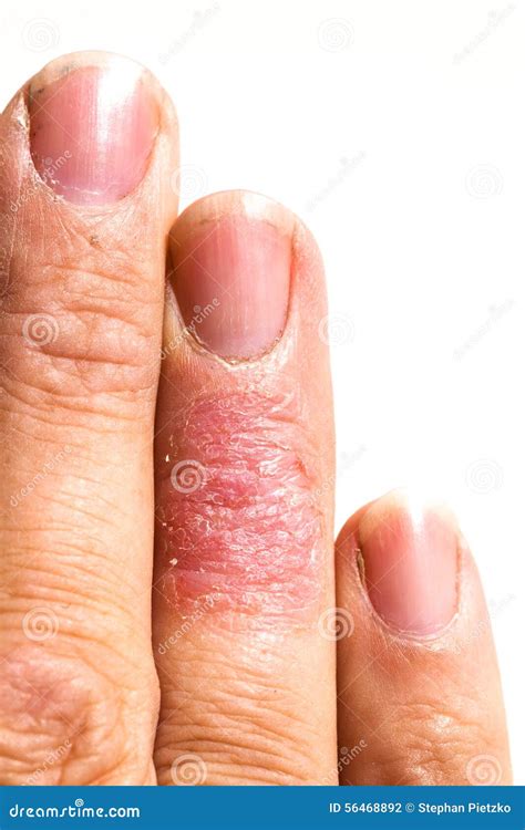 Ill Dematitis Allergic Skin Rash Eczema Finger Stock Photo Image Of