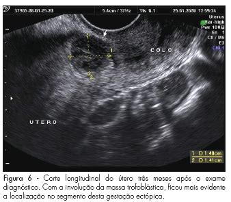 Por que a vasectomia afeta o orgasmo? Gravidez ectópica na cicatriz uterina de cesárea: relato ...