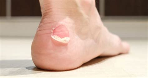 Blisters Our Simple Guide To Treating And Preventing Them