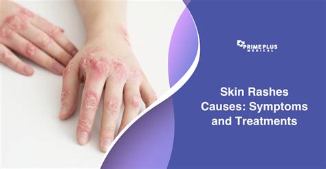 Skin Rashes Causes Symptoms And Treatments Prime Plus Medical
