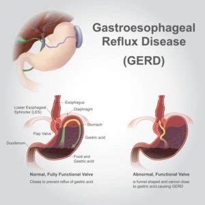 Gastro Esophageal Reflux Disease Fissi