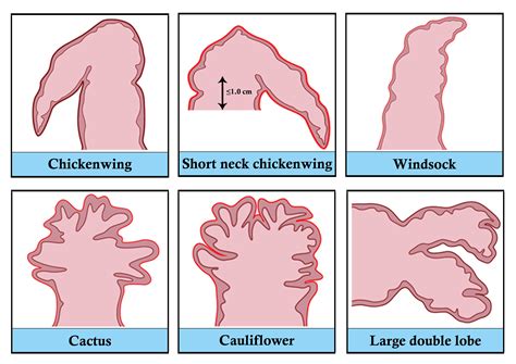 Left Atrial Appendage Morphology Types