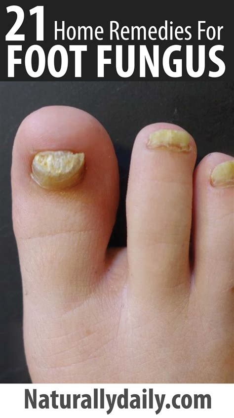 47 Cool Natural Home Remedies For Toe Fungus Home Decor Ideas