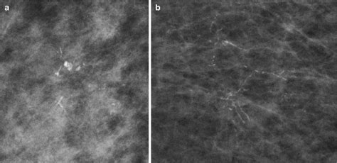 Ductal Carcinoma In Situ Anesthesia Key