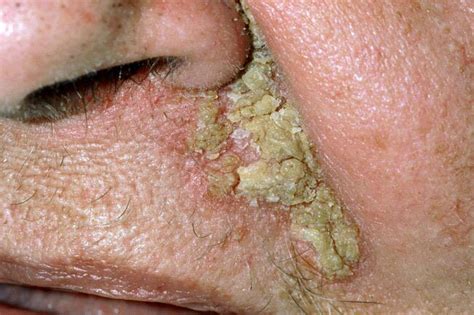 Skin Problems And Treatments Guide To Seborrheic Dermatitis