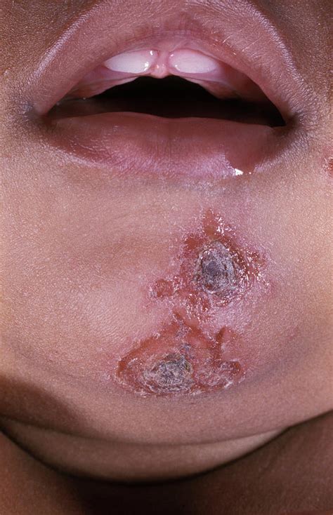 Congenital Skin Lesions Ph