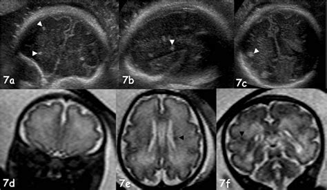 Figure 1 From Fetal Cerebral Imaging Ultrasound Vs Mri An Update