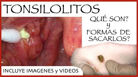Tonsilolitos 20 Por Qué Salen Y Cómo Se Tratan Youtube