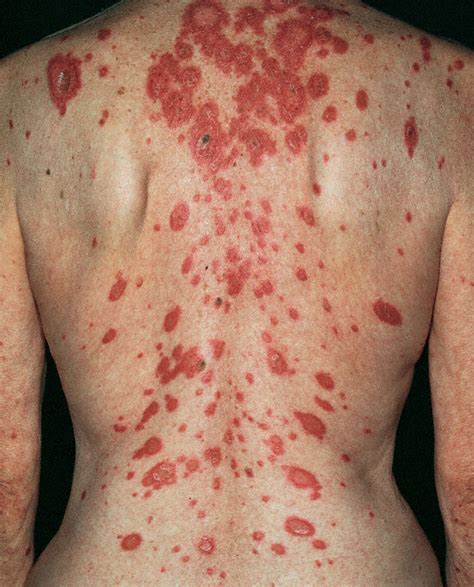 Subacute Cutaneous Lupus Erythematosus Scle الذئبة الحمامية الجلدية