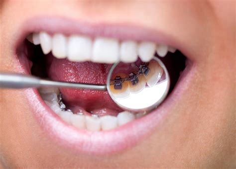 Lingual Braces In Cardiff Birchgrove Dental Practice