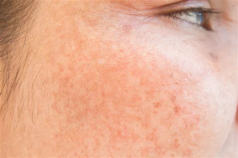 What Causes Dark Spots On The Skin And What Works To Reduce Them