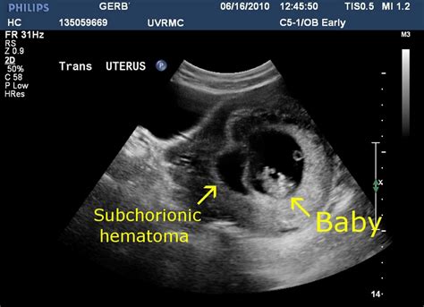 Subchorionic Hemorrhage Causes Complications In Pregnancy The