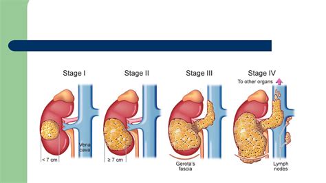 What Are The Different Types Of Renal Tumor With Pictures Kulturaupice