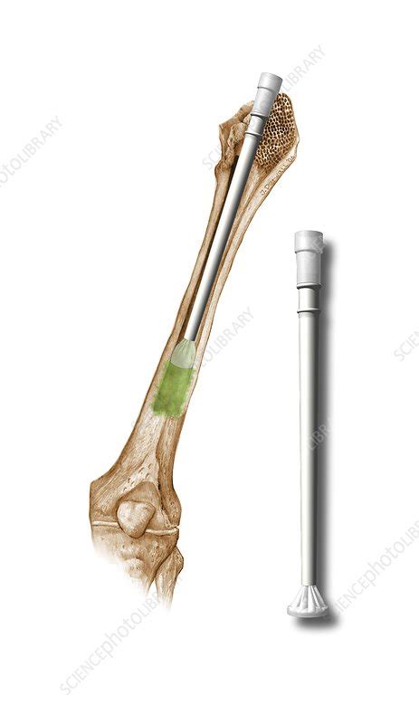 Hip Replacement Artwork Stock Image C009 7622 Science Photo Library