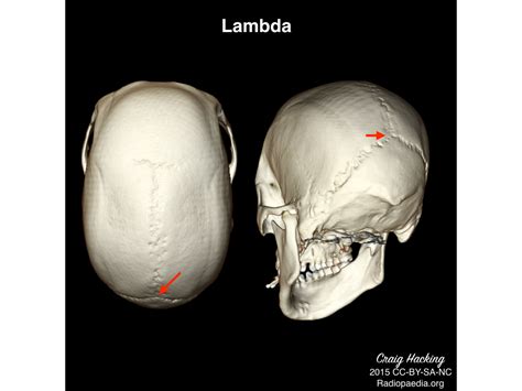 Skull Facial Bones And Paranasal Sinuses Flashcards
