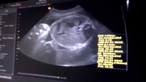 Usg atau ultrasonografi adalah pemeriksaan yang ini tergantung dari kejelasan gambar dan kemampuan dokter dalam menafsirkan gambar tersebut. Perkembangan Janin 8 bulan / 33 minggu #BabyG (USG Bayi ...