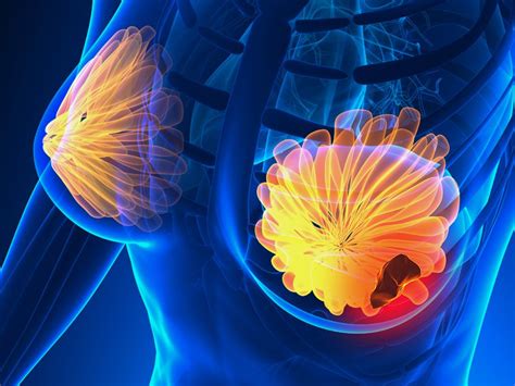 She places a high premium on. How to Deal With Breast Cancer - Every Woman Should Know ...