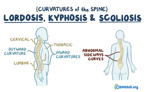 What Causes Scoliosis Of The Spine Scoliosis Therapy Centers