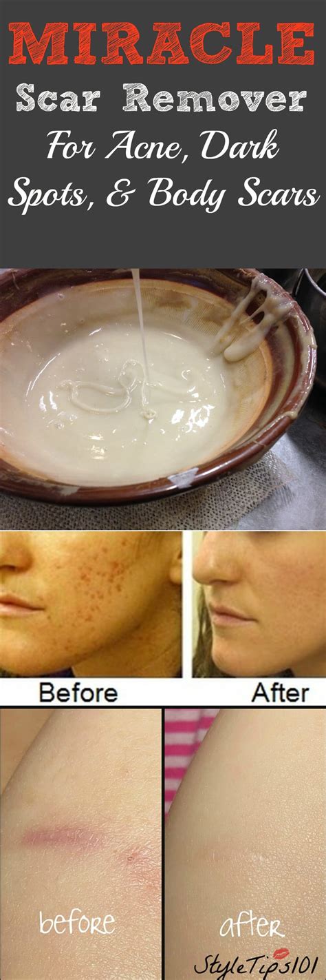 Miracle Homemade Scar Remover For Acne And Dark Spots