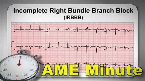 AME Minute Why Is An Incomplete Right Bundle Branch Block Considered A