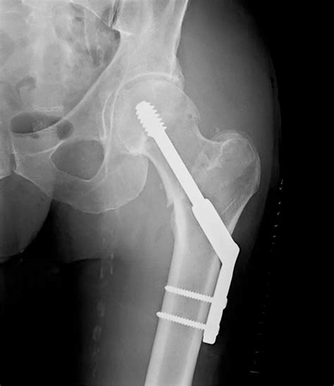 Hip Fracture Diagnosis Treatment And Secondary Prevention Aafp