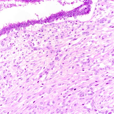 Pathology Outlines Phyllodes Tumor