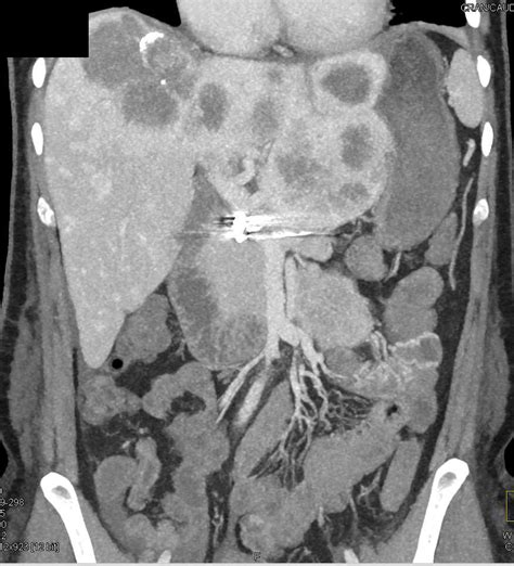 Liver Metastases From A Carcinoid Tumor Liver Case Studies Ctisus